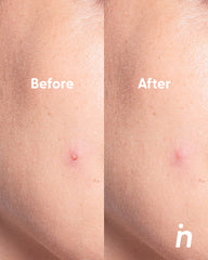 Invisible Hydrocolloid Patches for Pimples - Spot Me Here x2