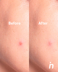 Hydrocolloid Patches with Microcapsules for Blind Pimples - My Way Out