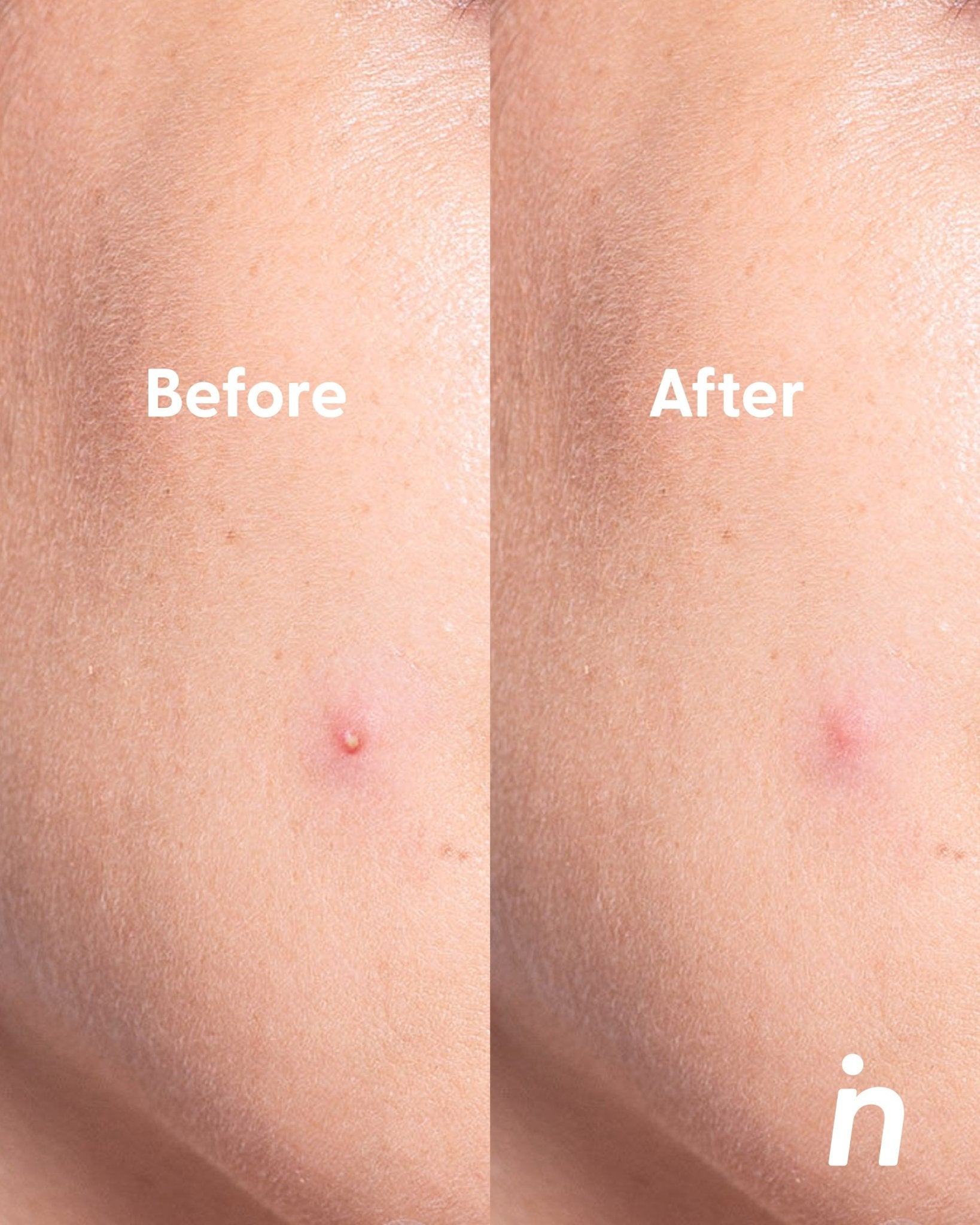 Invisible Hydrocolloid Patches for Pimples - Spot Me Here - Nipskin Stickwear™